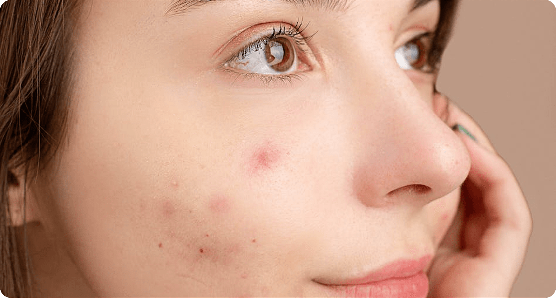 Compounding for Acne